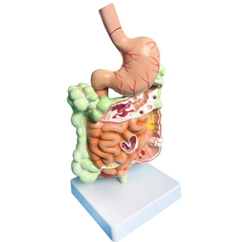 Kuņģa Anatomija Taisnās Zarnas Bojājumu Modelis Cilvēka Resnās Zarnas Resnās Zarnas Patoloģijas Slimību Modeļa Medicīnisko Organizators Anatomija